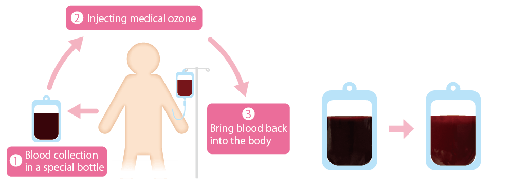 Flow of blood ozone therapy
