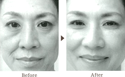 Inject hyaluronic acid nose, chin, lips, smile lines and cheek, wrinkles under eyes. Also Botox jaw injection, forehead ...