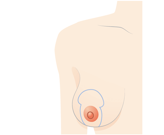 乳輪周囲から乳房下部にかけて切開する範囲をデザイン