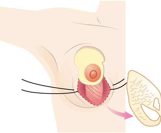 乳房下部の余剰脂肪と乳腺を一部切除。切除量は下垂の程度により決定