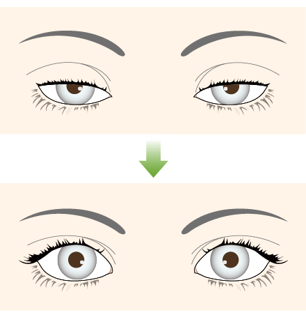 Buried heavy acupuncture (upper eyelid double buried method)
