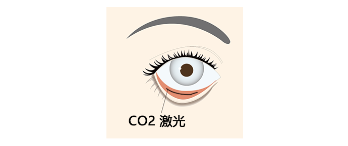 下眼睑部分脱脂术（CO2激光治疗）