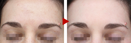 Pico laser rejuvenates the skin with Dr. Eri's method