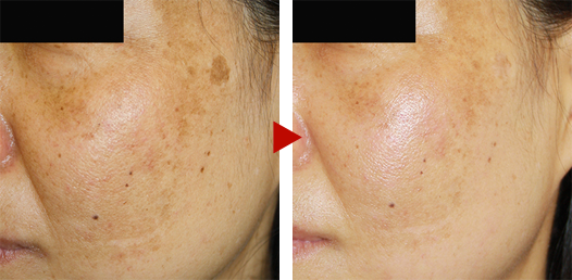 Pico laser treats pigment spots according to Dr. Eri's method