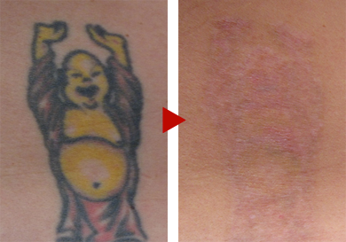 Pico laser removed the tattoo according to Dr. Eri's method