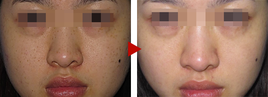 Pico laser toning according to Dr. Eri's method