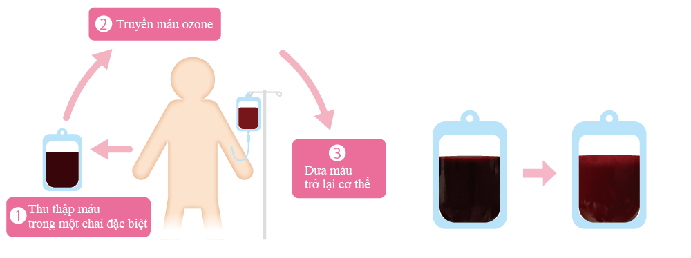 Dòng chảy của liệu pháp ozone máu