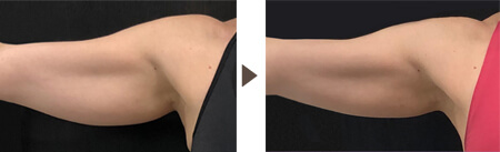 Treatment of biceps ※ 10 weeks after one treatment 