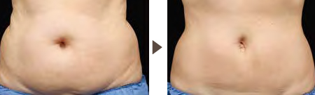 Abdominal - 8 weeks after one treatment