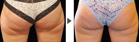 Buttock - 4 weeks after 2 treatments