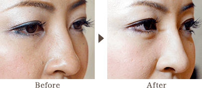 A eye bag has been created as well as the ridge of the nose has been arranged to become the brilliant and fascinating impression