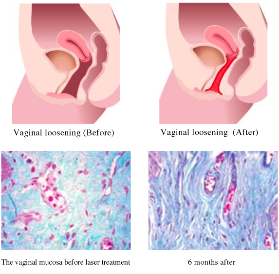 膣内にレーザーを照射することでコラーゲン再生