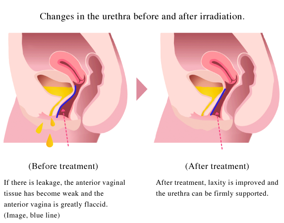 尿もれ改善