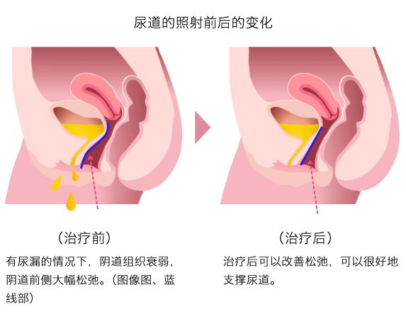 尿もれ改善