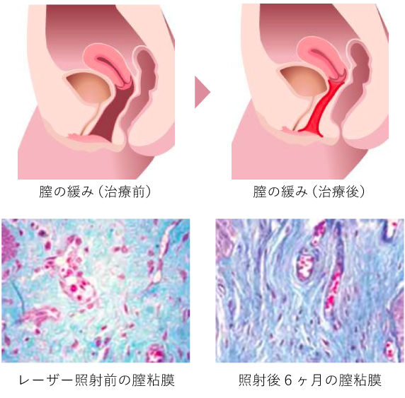 膣内にレーザーを照射することでコラーゲン再生