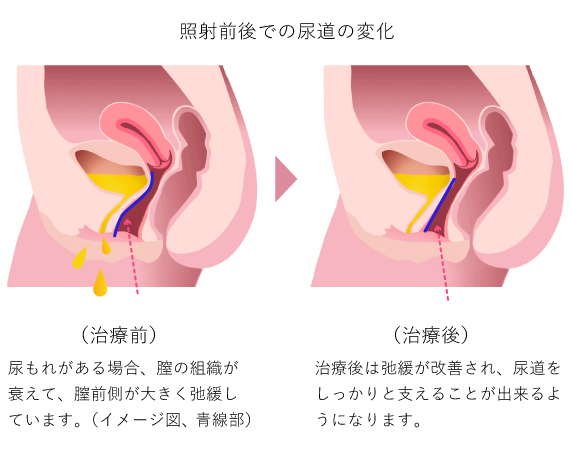 尿もれ改善