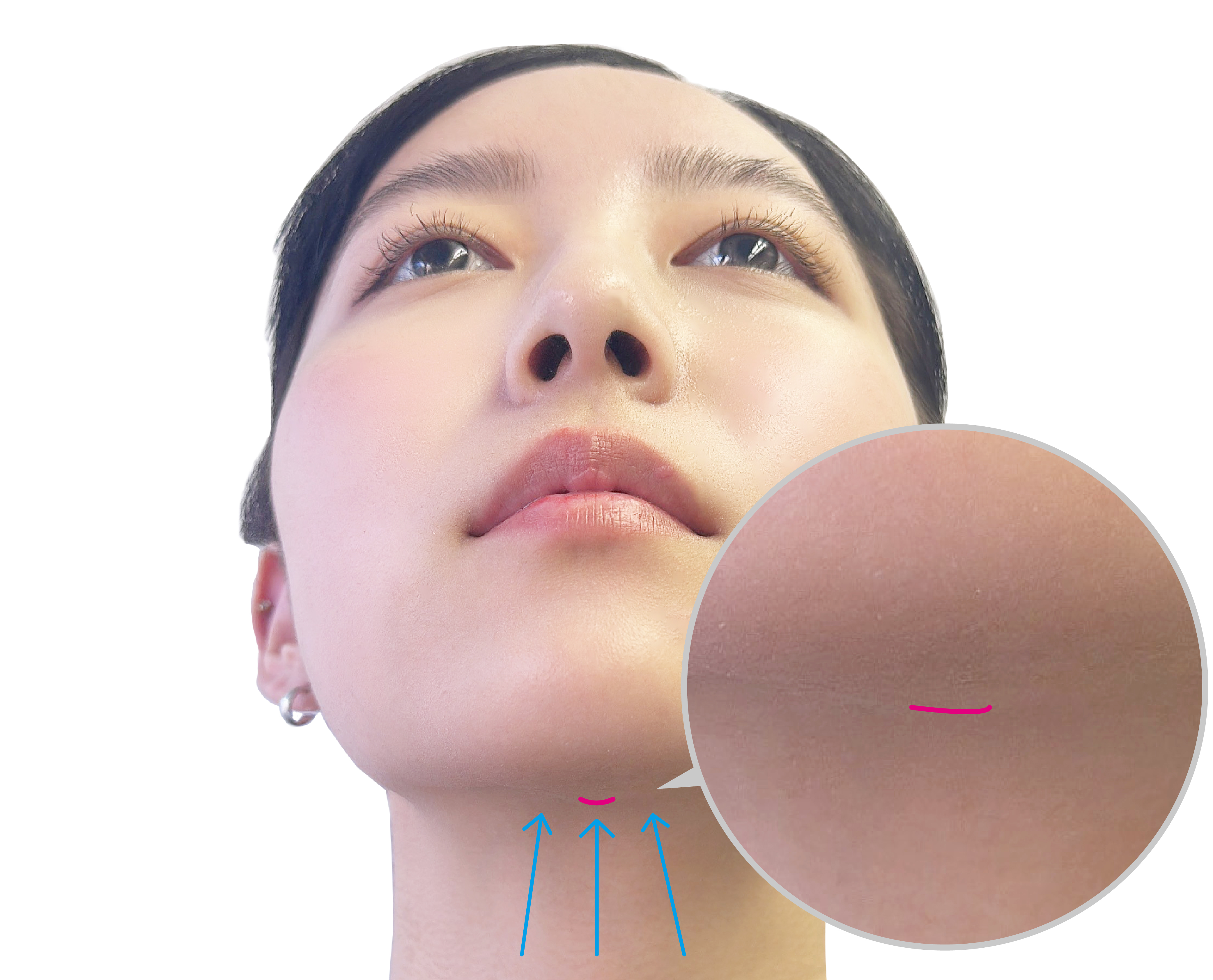 Submandibular lift Image