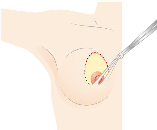 Cut the epidermis along the marked line