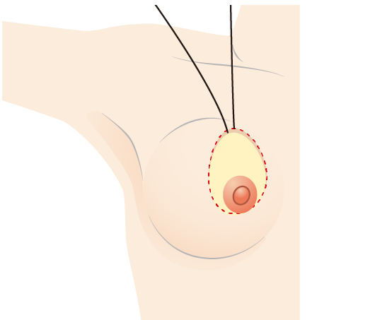 收集乳腺组织和脂肪，向上移动，同时缝合外周