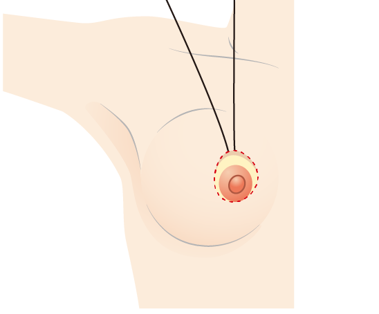  The outer skin is drawn around the areola by purse string stitching