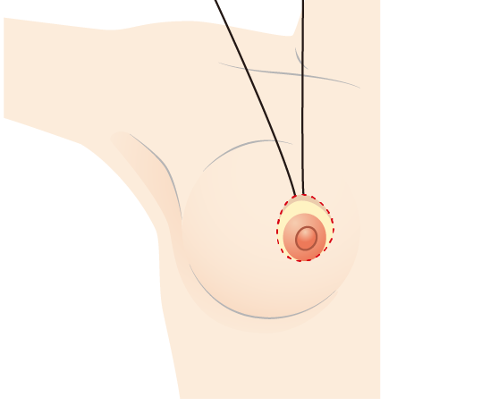 外周表皮は巾着縫合により、乳輪の周囲によってくる