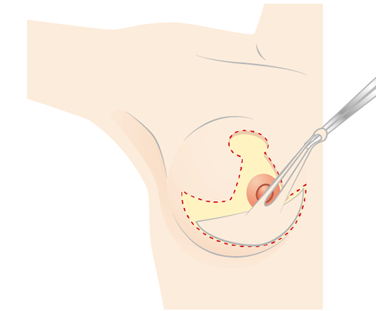 Excise breast epidermis and excess fat according to design