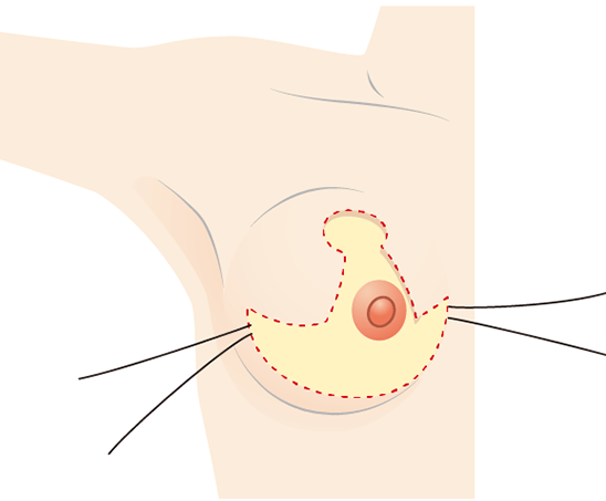 Loại bỏ mỡ thừa và một phần tuyến vú ở phần dưới bầu ngực