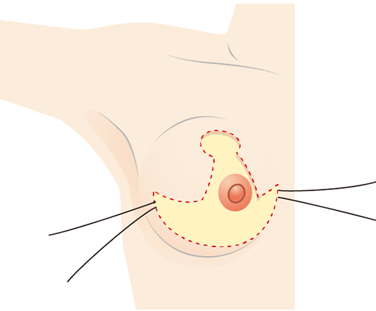  Excise excess fat and partial wrinkles of the mammary gland from the lower breast