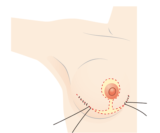 缝合切口区域使其呈倒T形。 那时，抬高以使乳晕位于上部圆形部分
