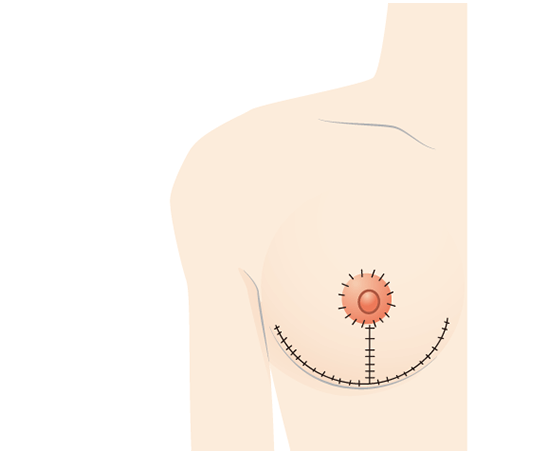 小心地在乳晕周围和乳房下面缝合。