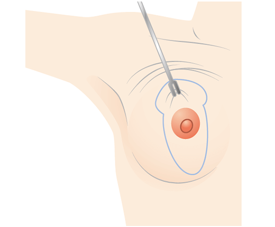 Nâng ngực lên vạch lý tưởng