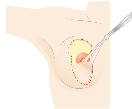 Cut the skin along the incision line