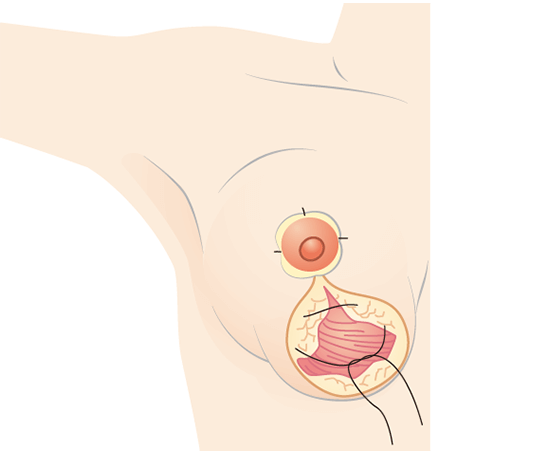 Khâu các lớp mỡ bên trái và bên phải