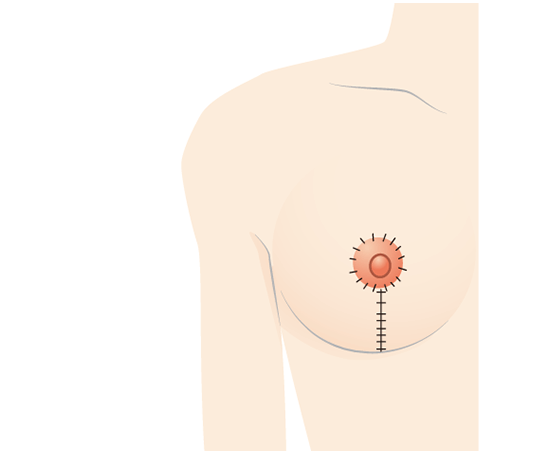 皮膚を縫合し、終了。傷跡は乳輪周囲と縦方向の傷跡のみ。