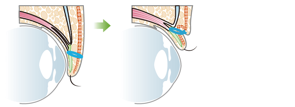 埋没式重瞼術（上まぶた二重埋没法）
