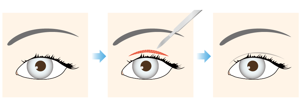 Total incision barotomy (double incision on the upper eyelid)