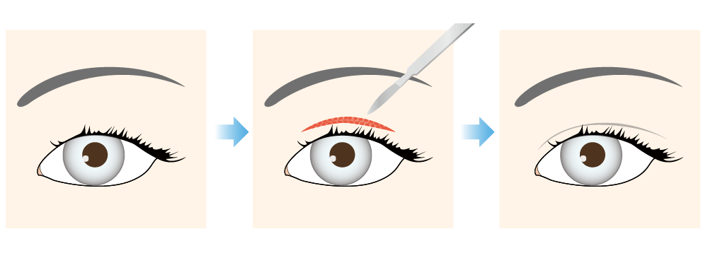 全切開重瞼術 （上まぶた二重切開法）