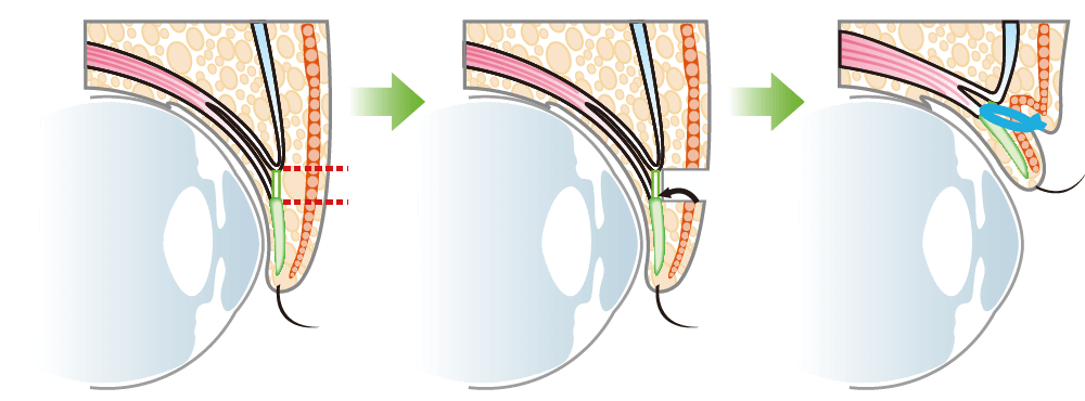 Total incision barotomy (double incision on the upper eyelid)