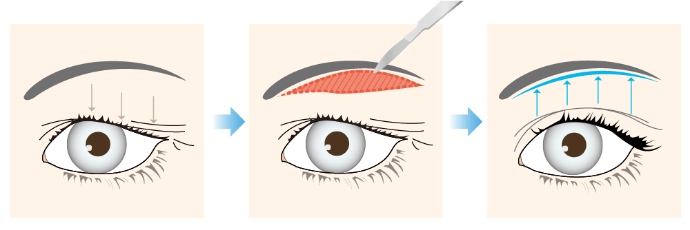  Incision under the eyebrows