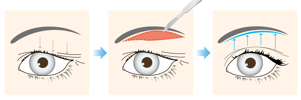 Rạch xoá nhăn dưới lông mày