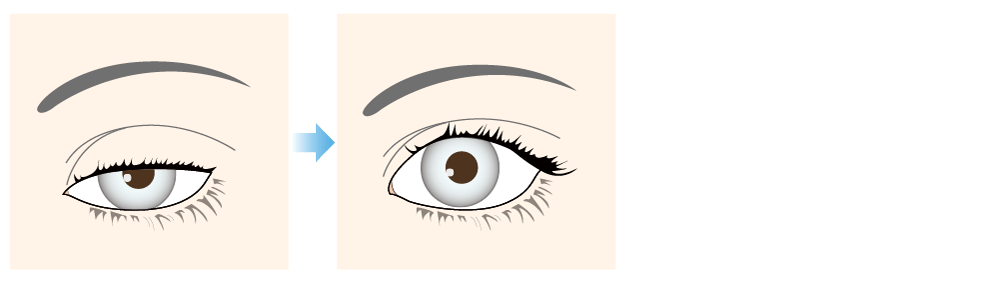 Eyelid droop surgery (incision)