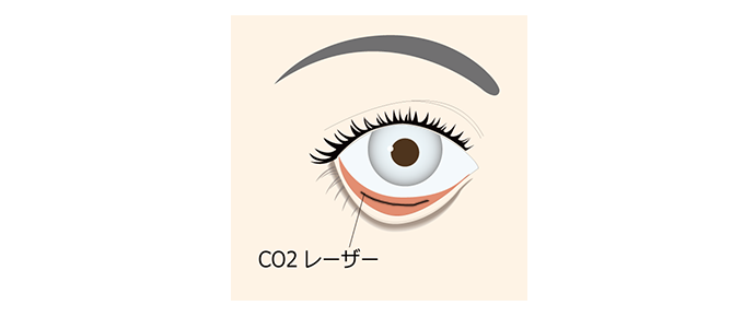 CO2レーザー