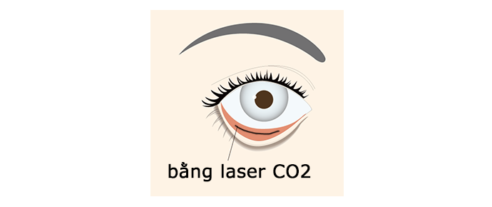 Loại bỏ cục bộ mỡ thừa mí mắt dưới (bằng laser CO2)