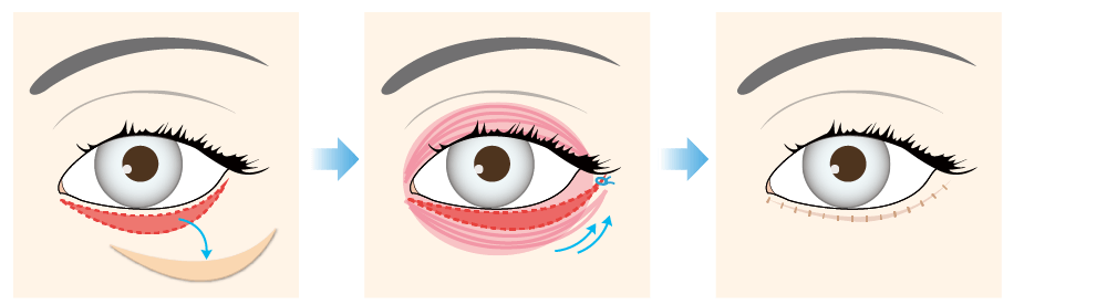 Percutaneous ablation (muscle flap method)