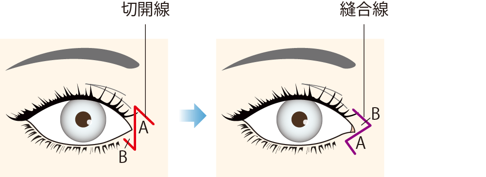 目頭切開法