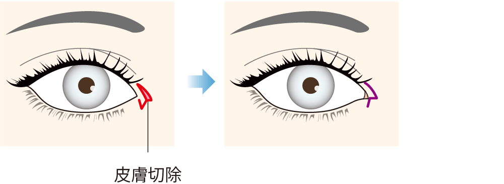 目頭切開法（Z形成 / W形成）