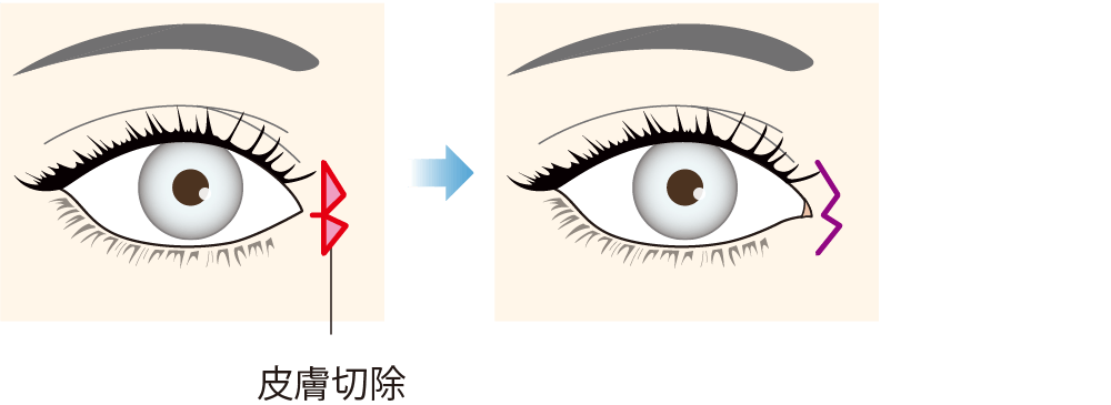 目頭切開法