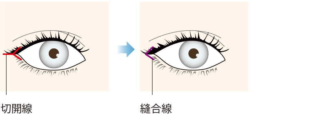 目尻切開法（V-Y法）