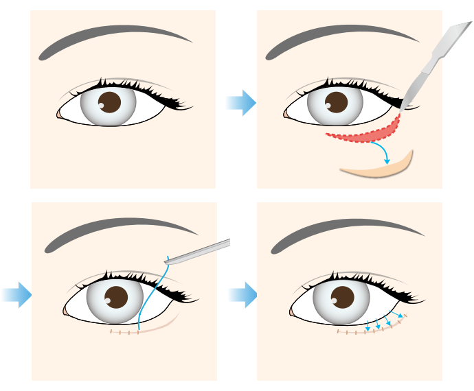 下眼瞼　(下まぶた）たるみ矯正術