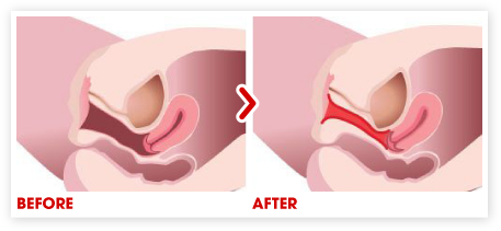 Cải thiện âm đạo bị giãn nở